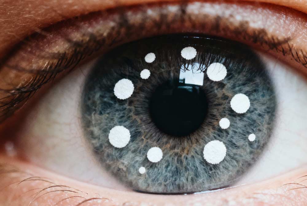 Manchas en los ojos en la parte blanca: causas, síntomas y tratamientos esenciales